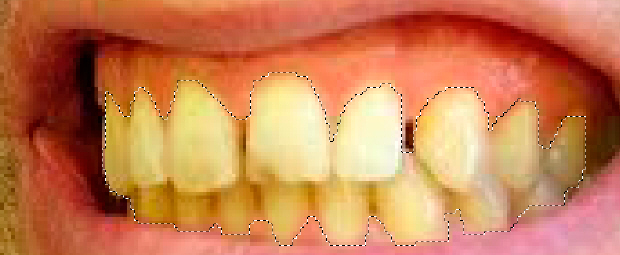 Выделение зубов произведено