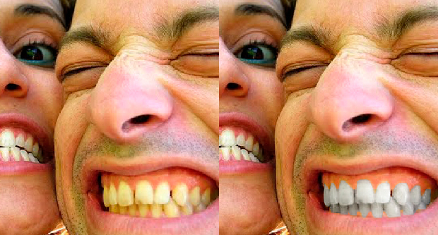 Зубы до (слева) и после (справа) отбеливания