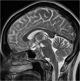 Томограмма (профиль) головного мозга  (после обработки на компьютере)