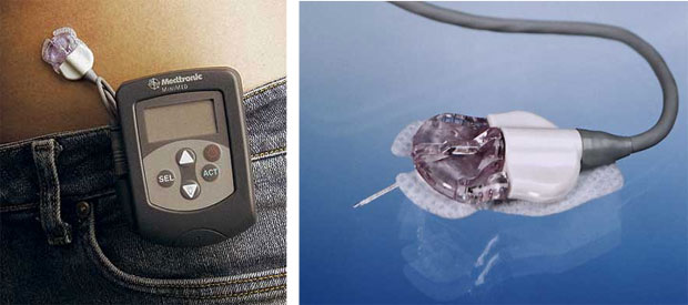 Портативный интеллектуальный сенсор CGMS System Gold для наблюдения в течение нескольких суток за изменениями концентрации сахара в крови человека: слева – расположение блоков сенсора на теле человека в процессе наблюдения; справа – ферментный электрод в крупном масштабе