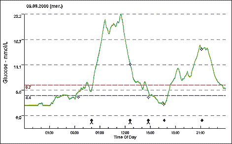 Пример графика изменения концентрации глюкозы в крови больного сахарным диабетом человека в течение суток, зарегистрированного сенсором CGMS System Gold