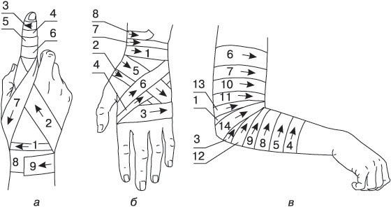 Повязки на верхние конечности: