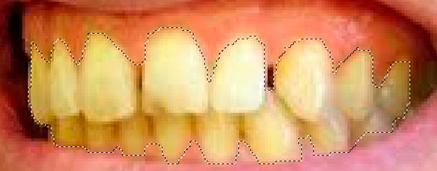 Выделение зубов произведено